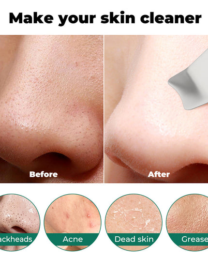 Ultrasonic Facial Beauty Device – 4-in-1 Deep Cleansing, Ion Therapy & Blackhead Removal