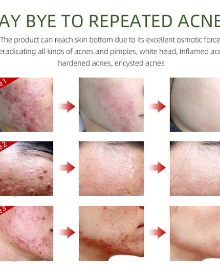 Herbal Acne Cream