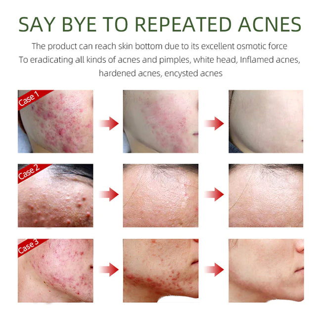 Herbal Acne Cream